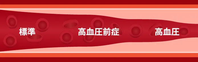 高血圧のイメージ